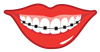 braces